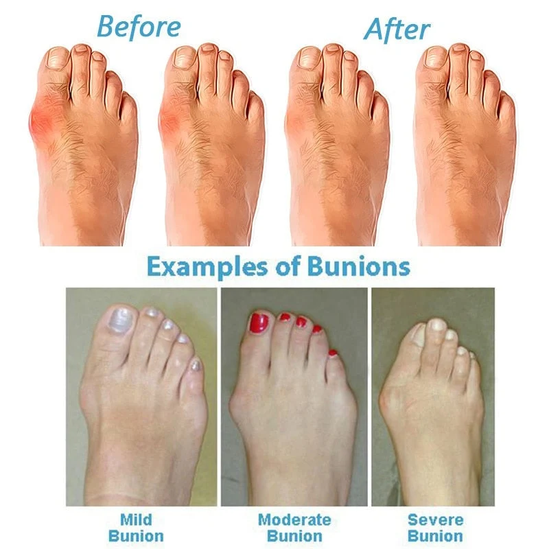 Orthop?dische Sandalen Damen - Bequeme Hallux Valgus Sommerschuhe mit anatomischem Fu?bett & verstellbaren Riemen f��r Halt