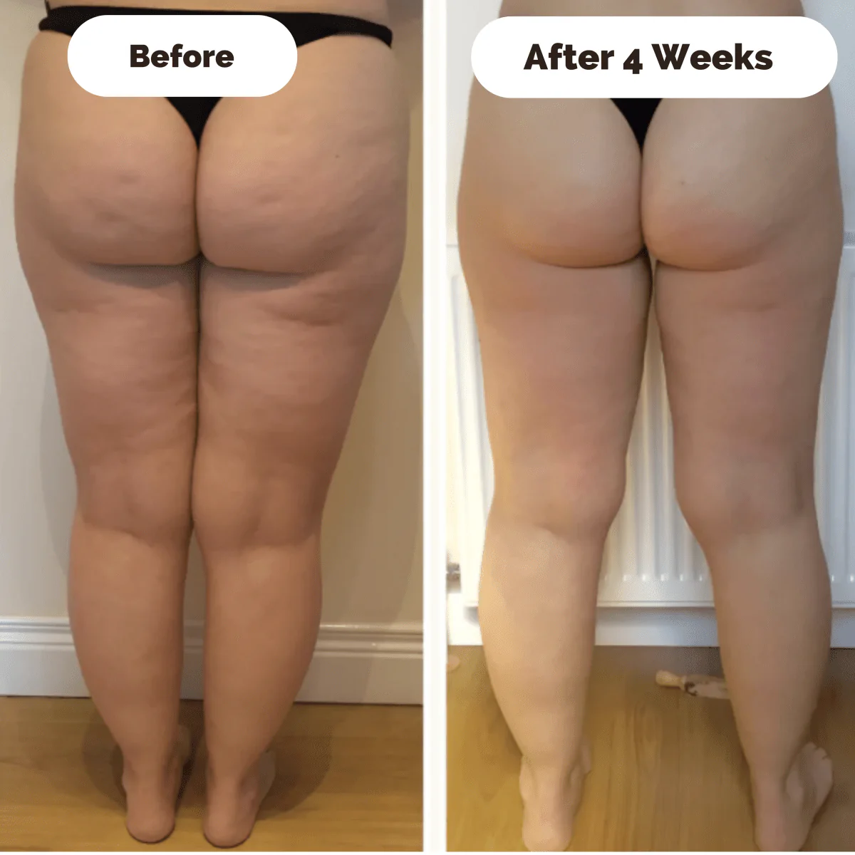 SKINLIFT – Aparato de masaje reafirmante para la piel contra la celulitis