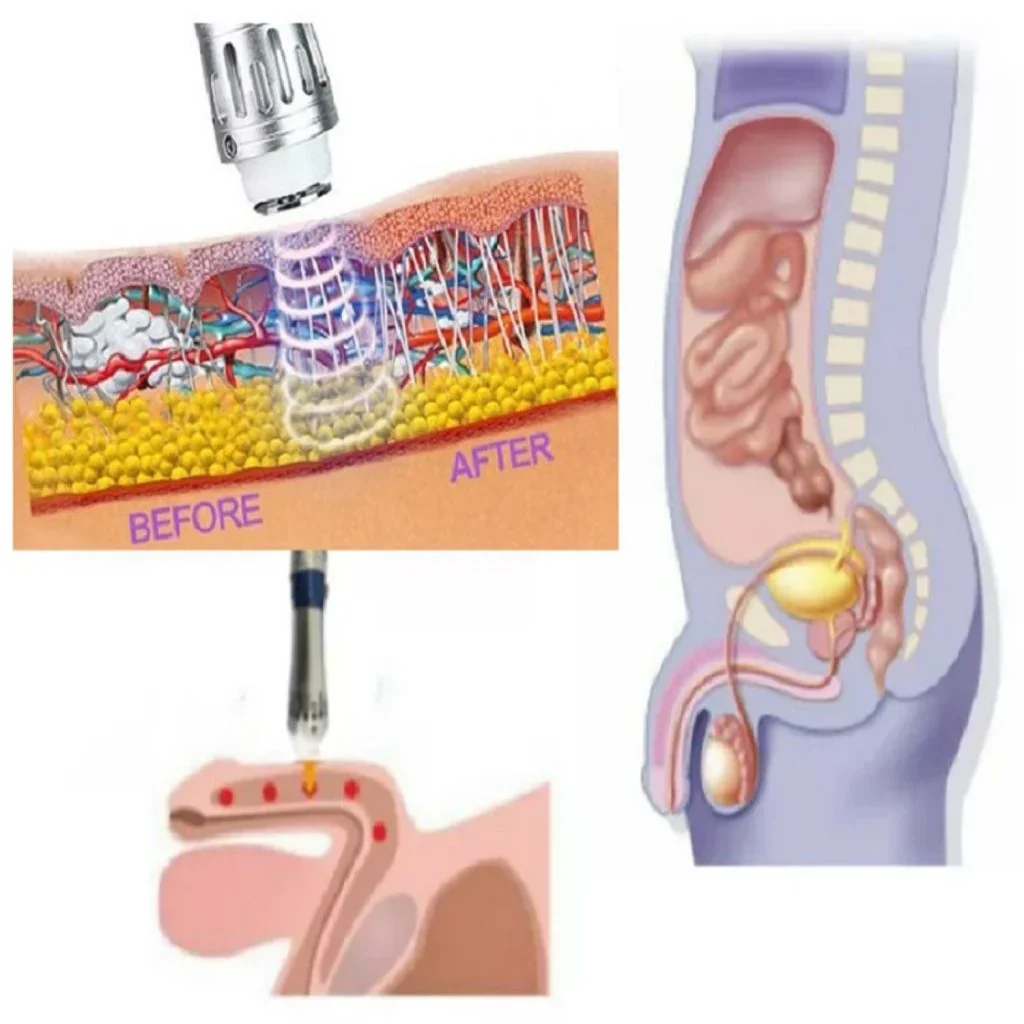 Dispositivo portátil de terapia de ondas de choque AeroPulse para hombres