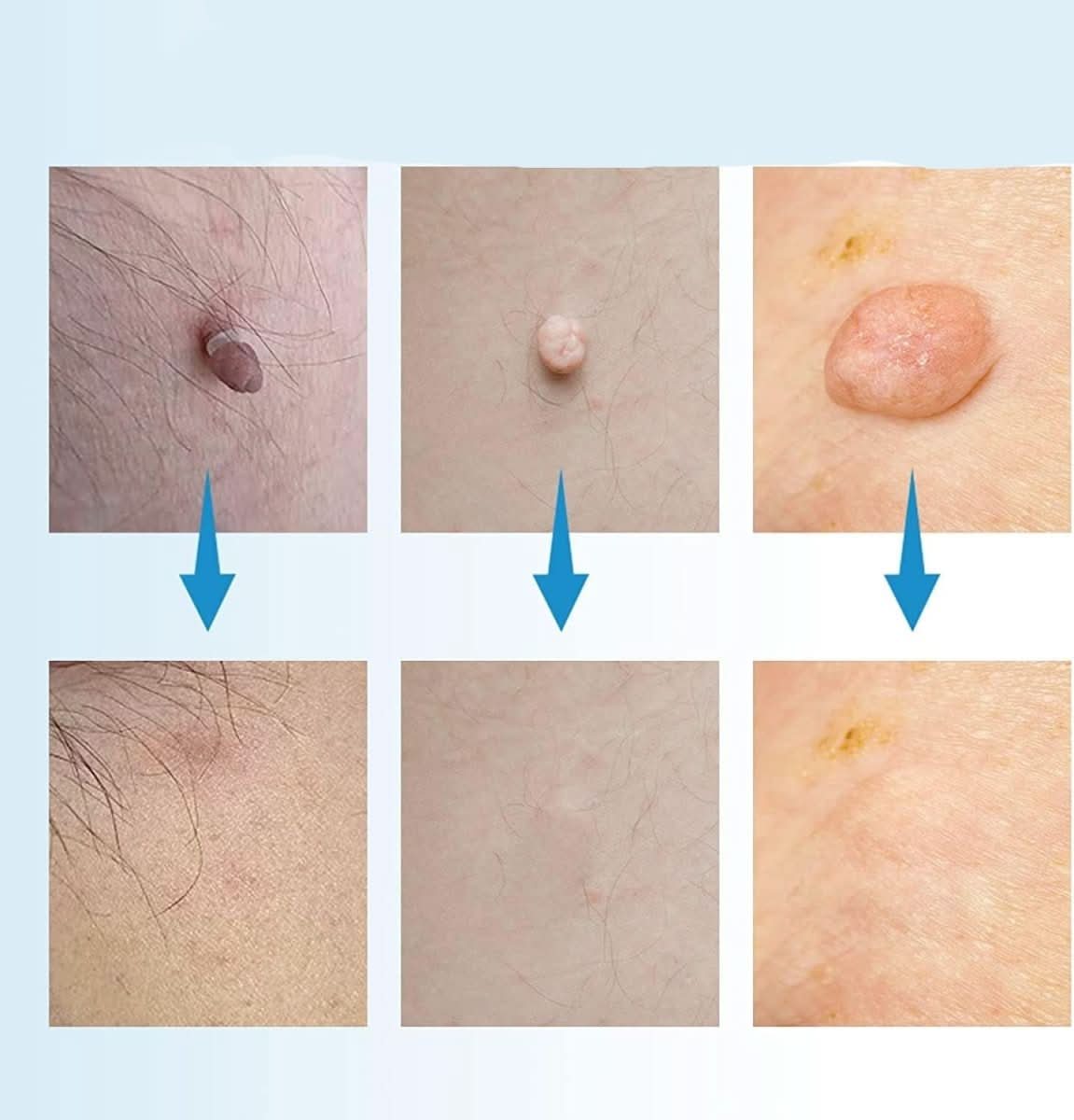 SpotOff Removedor de Verrugas Cutáneas – Eliminación indolora de manchas en el cuello, espalda y cuerpo